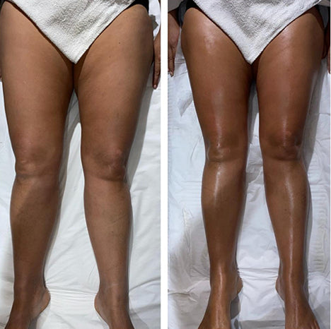 Customer before and after photo showing slimmer, smoother-looking legs